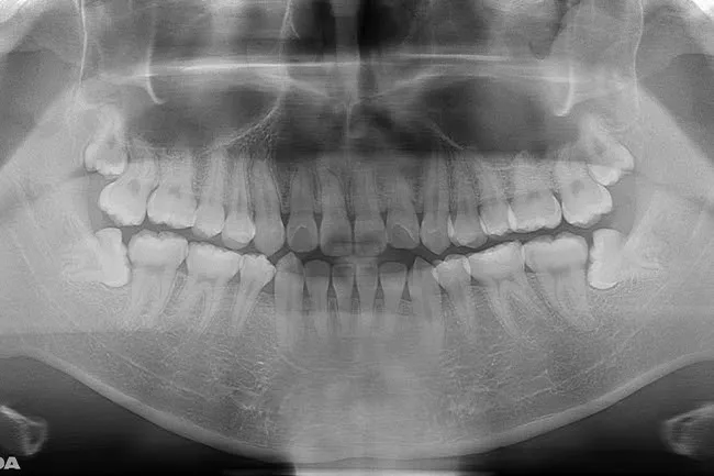 下の親知らずが2本とも真横を向いた状態のレントゲン写真