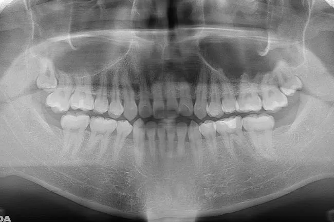 下の2本の親知らずを抜歯した後のレントゲン写真