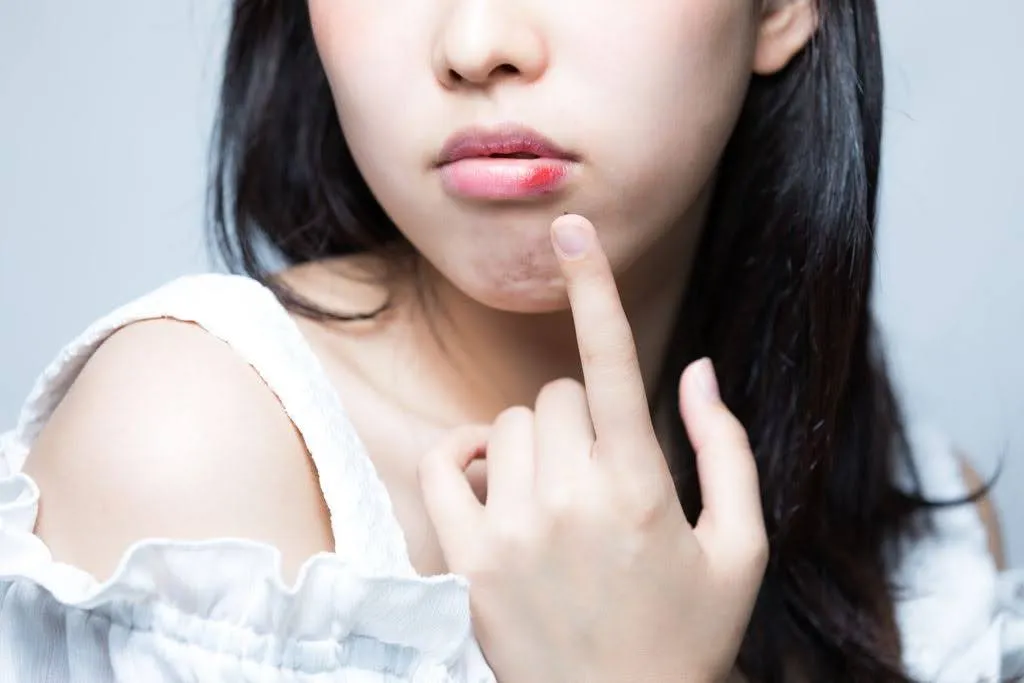 唇に怪我をした女性