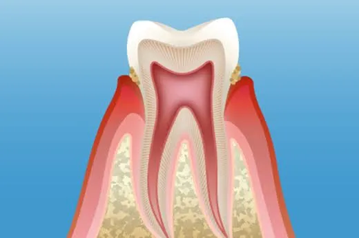 少量の歯垢がついた歯と炎症を起こし始めた歯肉