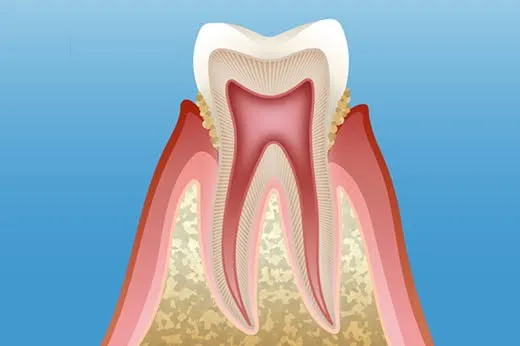 歯周炎が進み歯石が溜まった歯と歯肉