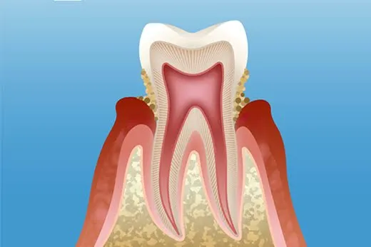 歯石がさらに溜まり歯茎に腫れが見られる歯と歯肉