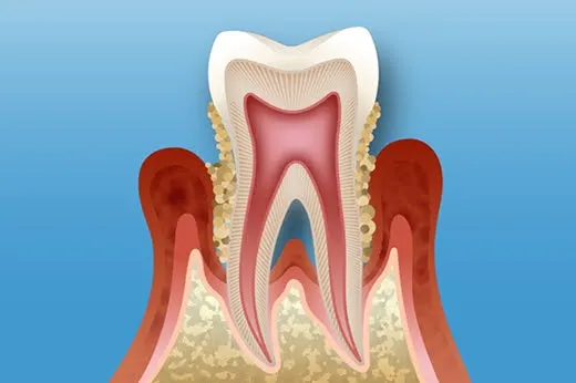 歯茎の腫れ歯を支えている骨がかなり溶けている歯と歯肉