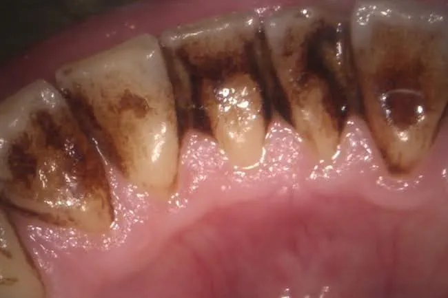 歯に歯石や汚れが沢山ついた口の中