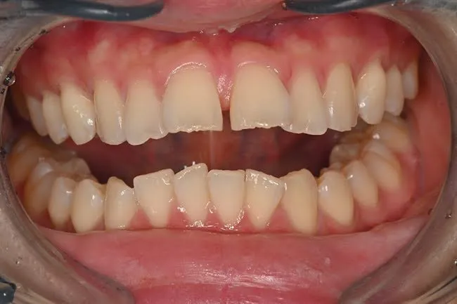 わずかに黄味がかった歯の写真