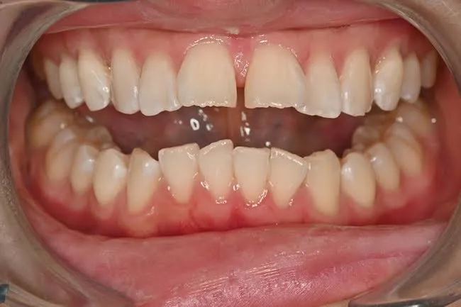 白くなった葉の写真