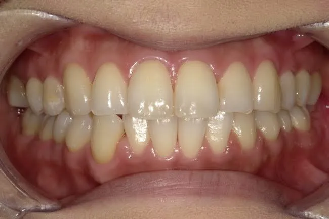 黄味がかった歯の写真