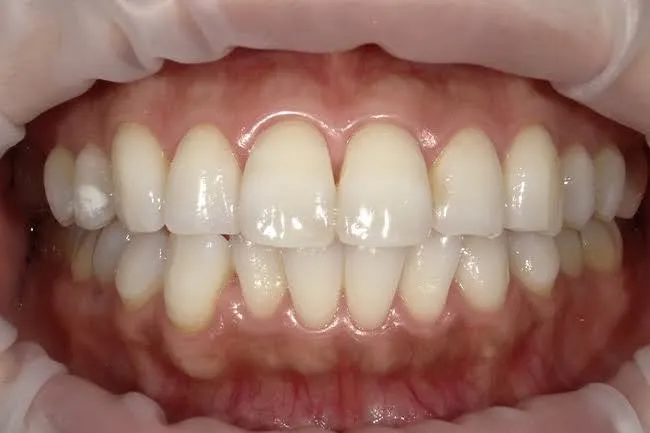 白くなった葉の写真